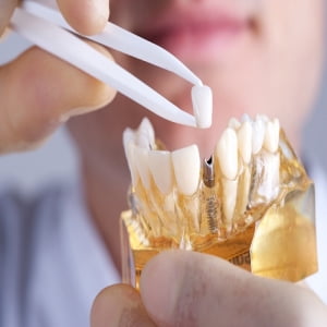 Trồng răng implant tại Nha khoa Nụ Cười