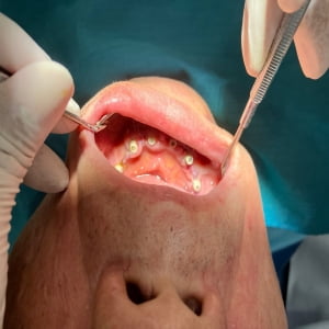 Trồng răng implant TOÀN HÀM  tại Nha khoa Nụ Cười
